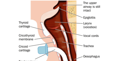 Tracheostomy_ORIGINAL_460x261